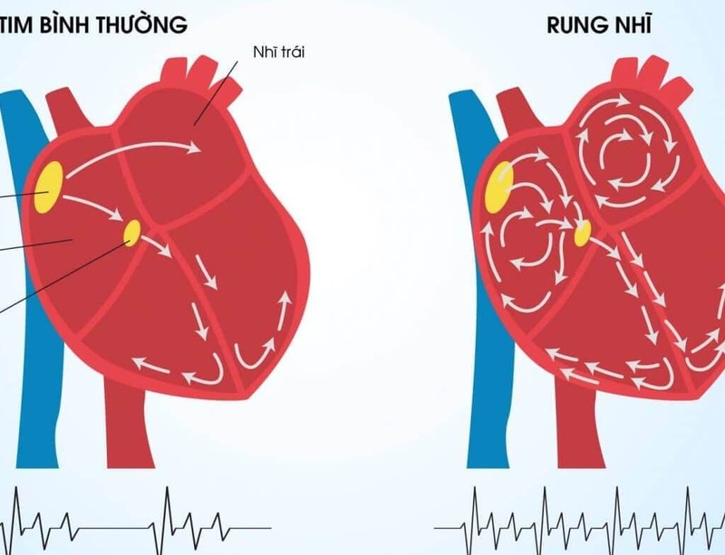 Thuốc làm loãng máu: Giải pháp ngăn ngừa đột quỵ ở người bệnh rung nhĩ 2
