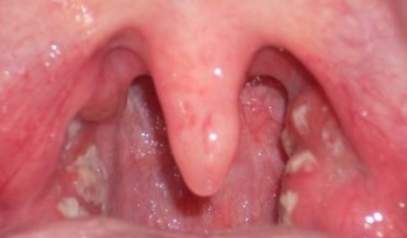 Nấm họng là gì?