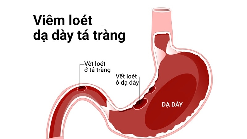 Thuốc Omeptul là thuốc gì? Những điều cần biết khi sử dụng thuốc Omeptul 2