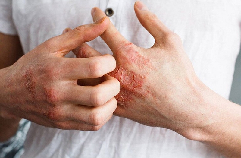 Thuốc Tomax có bôi được vùng kín không? Cách dùng kem bôi da Tomax Genta an toàn, hiệu quả 1