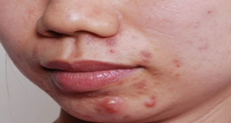 Thuốc tránh thai trị mụn nội tiết có hiệu quả không?