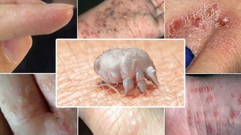 Thuốc trị ghẻ: Giải pháp hiệu quả cho vấn đề ngứa không tưởng 1