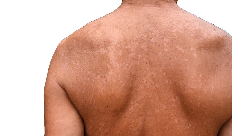 Lang beng ở lưng tuy không gây nguy hiểm nhưng lại có tốc độ lây lan nhanh, và khó trị dứt điểm