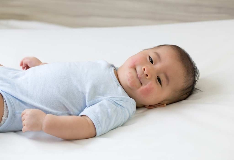 thuốc trị mẩn ngứa cho bé nào tốt