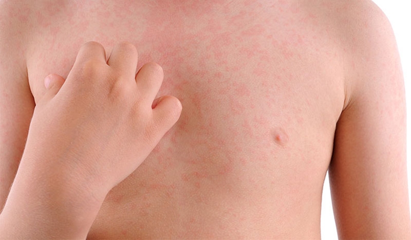 Nổi mề đay ở trẻ em có nguy hiểm không? 3