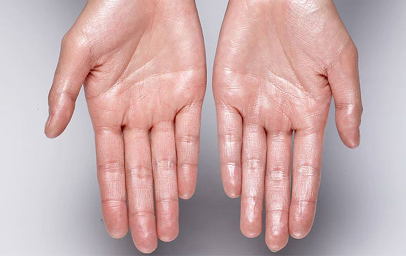Thuốc trị mồ hôi tay chân có hiệu quả không?
