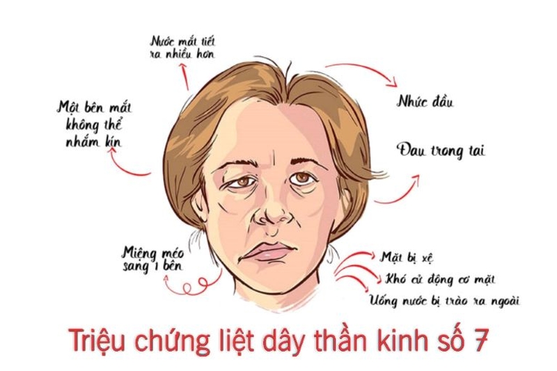 Bệnh liệt dây thần kinh số 7