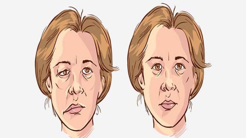 Nhưng lưu ý khi điều trị liệt dây thần kinh số 7