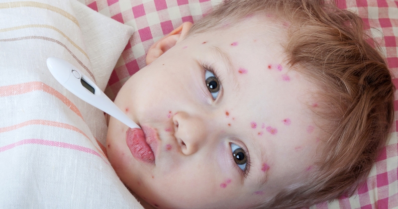 Thủy đậu biểu hiện như thế nào và một số lưu ý khi điều trị 1