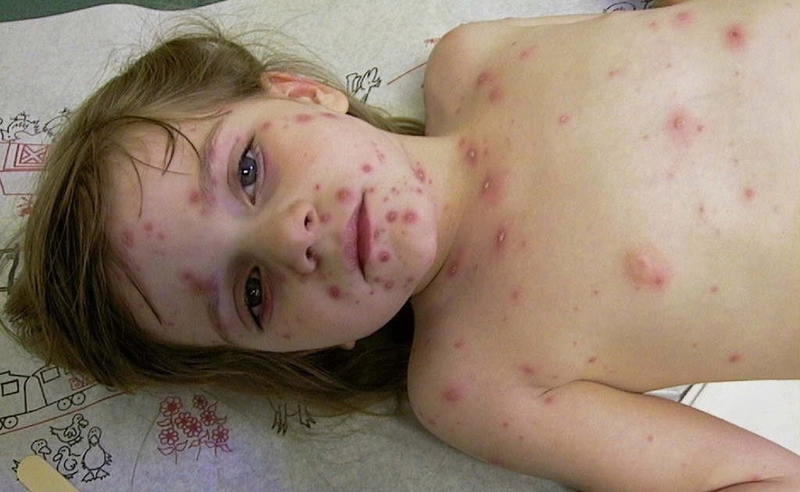 Thủy đậu có để lại sẹo hay không và cách hạn chế sẹo 1