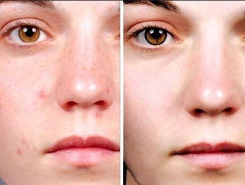 Thủy đậu có để lại sẹo hay không và cách hạn chế sẹo