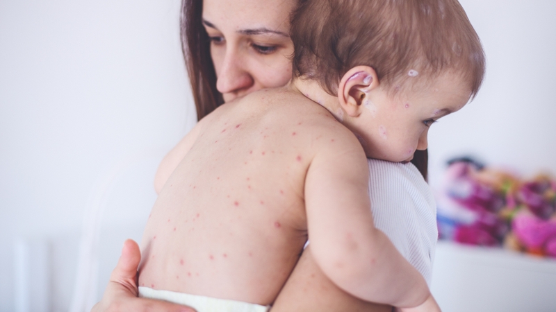 Thủy đậu có kiêng gió không? 2