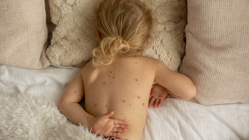 Thủy đậu có kiêng gió không? 3