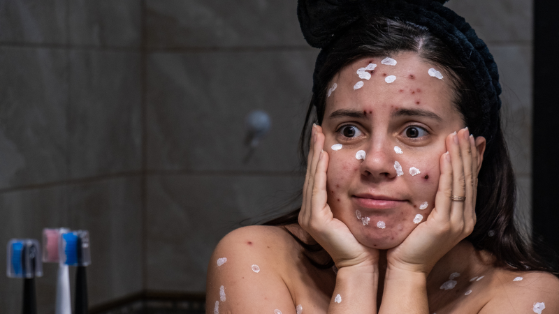 Thủy đậu có lây sang người lớn không là câu hỏi khiến nhiều người lo lắng