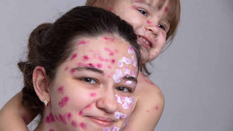 Nhiều ca thủy đậu ở người lớn được ghi nhận khi chăm sóc trẻ mắc bệnh