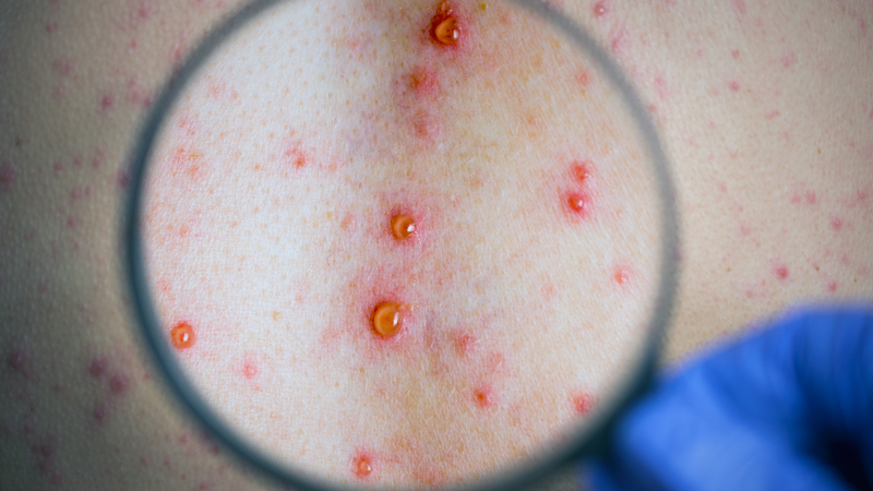 Thủy đậu do Varicella Zoster virus gây ra, thường gặp ở trẻ em