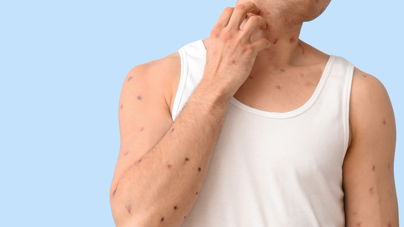 Không gãi hay bóc vảy thủy đậu để hạn chế nguy cơ để lại sẹo