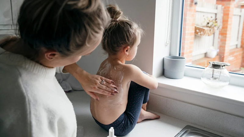 Thủy đậu đóng vảy đã khỏi chưa? Dấu hiệu cụ thể từng giai đoạn 4