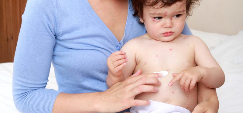 Thủy đậu gội đầu có nguy hiểm không? 3