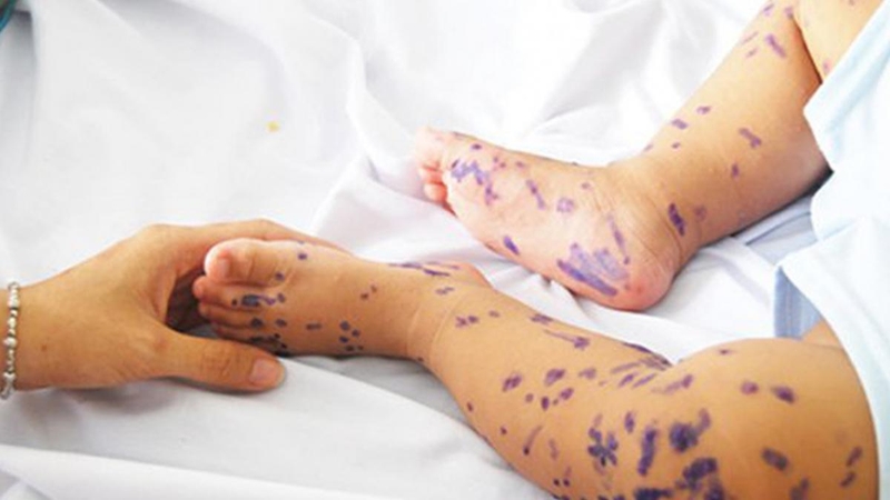 Thủy đậu Herpes là gì? 2