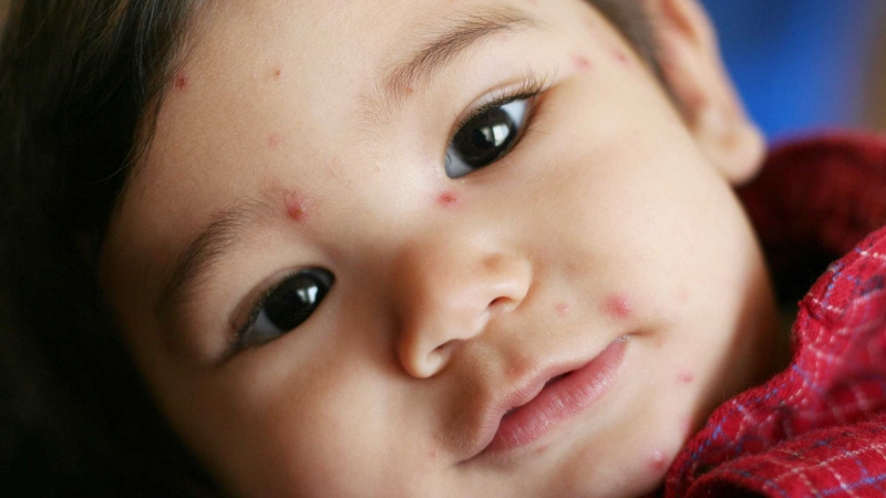 Thủy đậu Herpes là gì? 3