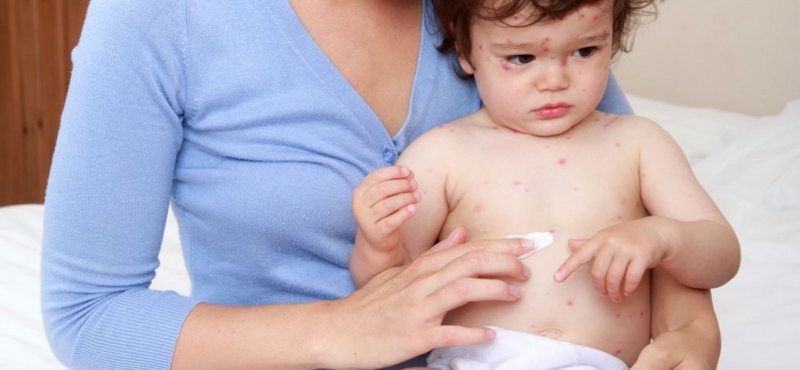 Thủy đậu mọc ở đâu trước: dấu hiệu dễ nhận biết nhất