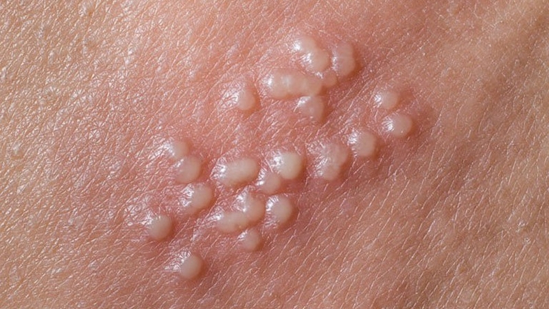 Thủy đậu mọc ở vùng kín có sao không? 2