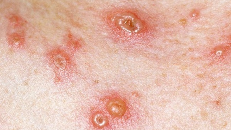 Thủy đậu mọc ở vùng kín có sao không? 1