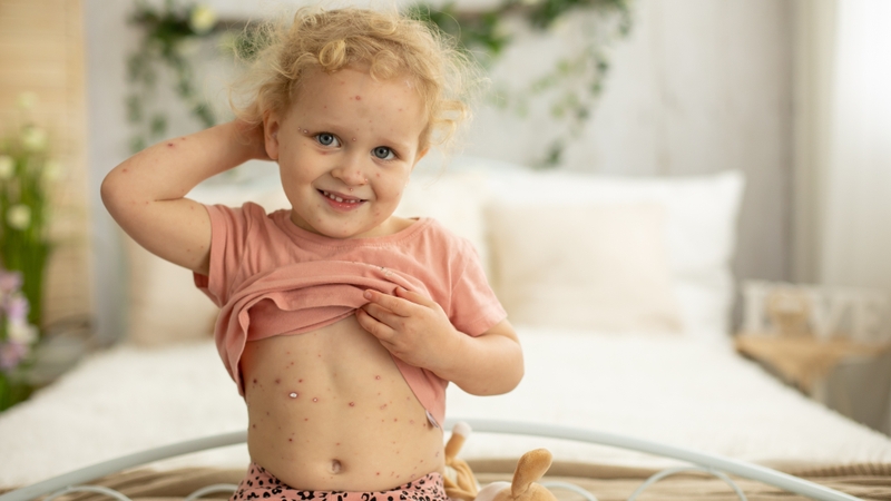 Nguyên nhân và phương pháp điều trị tình trạng thủy đậu mọc quá nhiều 2