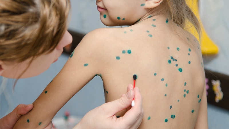 Nguyên nhân và phương pháp điều trị tình trạng thủy đậu mọc quá nhiều 4