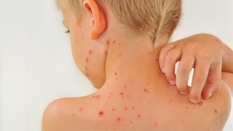 Thủy đậu mọc trong miệng có nguy hiểm không? 1