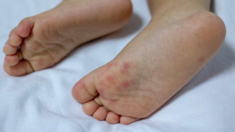 Thủy đậu mọc trong miệng có nguy hiểm không? 3