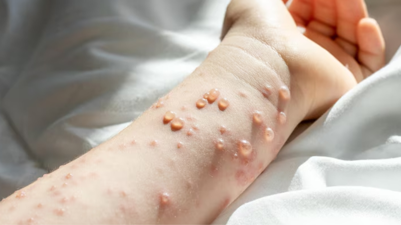 Thủy đậu mới phát thường có biểu hiện như thế nào? 1