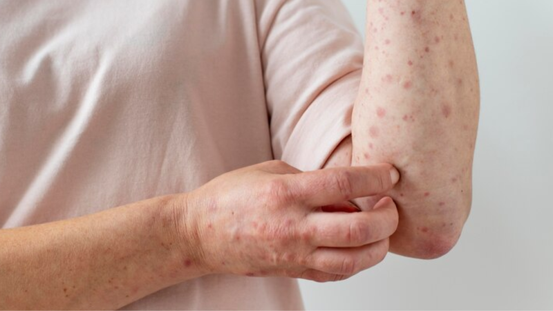 Thủy đậu mới phát thường có biểu hiện như thế nào? 2