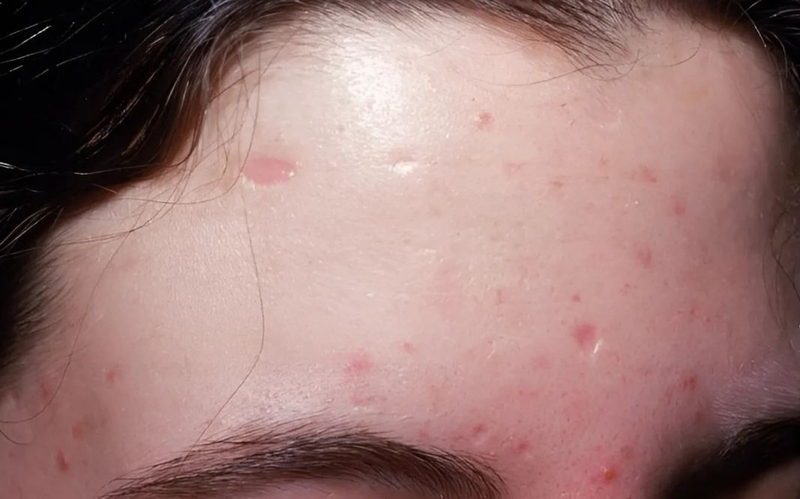 Nên làm gì khi mụn thủy đậu nổi nhiều ở mặt 2