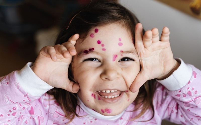 Nên làm gì khi mụn thủy đậu nổi nhiều ở mặt 3