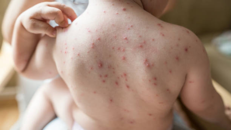 thuy-dau-o-tre-so-sinh-nguyen-nhan-trieu-chung-va-cach-dieu-tri 2