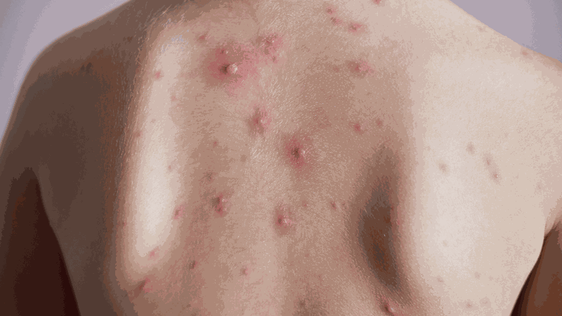 Thủy đậu sốt mấy ngày thì khỏi? 1