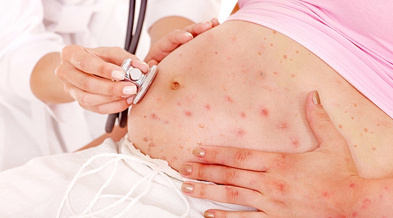 Thủy đậu trong thai kỳ và nguy cơ thủy đậu bẩm sinh 1