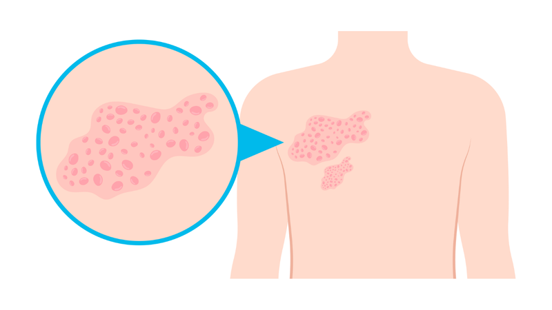 Thủy đậu và Rubella: Những khác biệt quan trọng cần biết 3