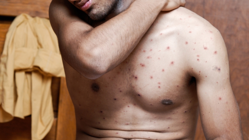 Thủy đậu gây vô sinh 2