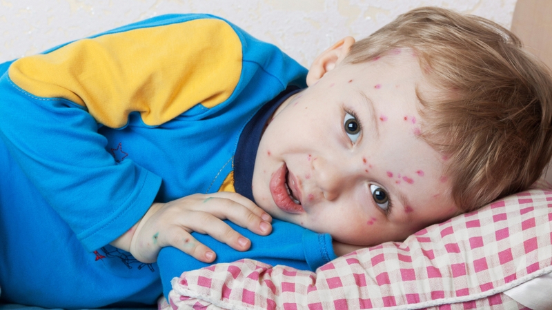 Thủy đậu gây vô sinh 0