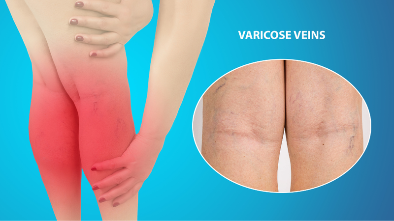 thuyen-tac-huyet-khoi-tinh-mach-la-gi-trieu-chung-va-dau-hieu-nhan-biet 3