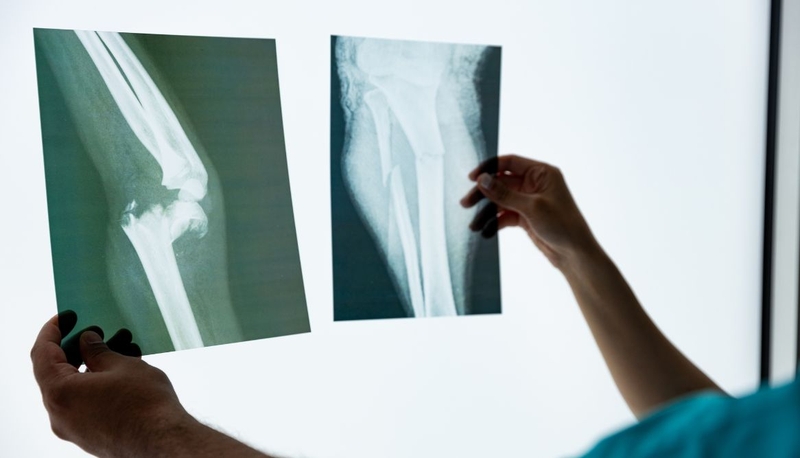 Thuyên tắc mỡ: Chi tiết nhất về nguyên nhân, triệu chứng, cách điều trị 2