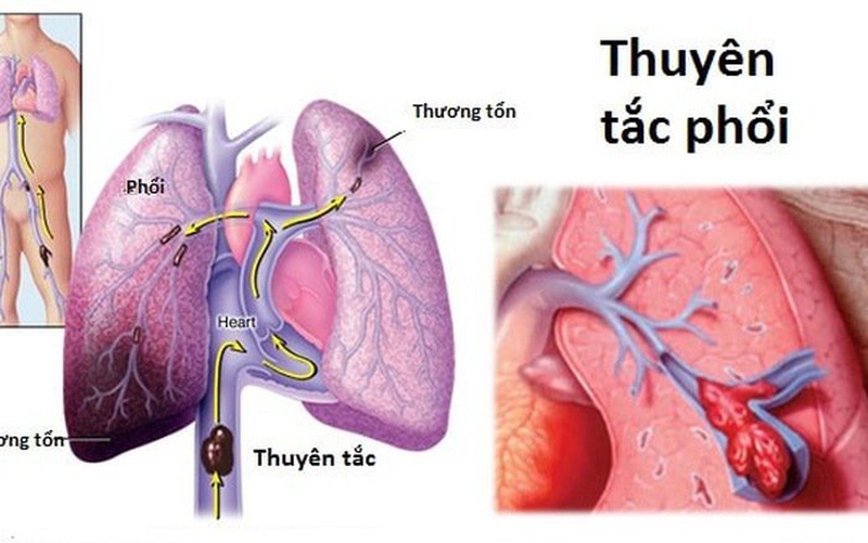 Thuyên tắc phổi có thể gây tử vong với tỷ lệ khoảng 30% đối với những trường hợp không được điều trị