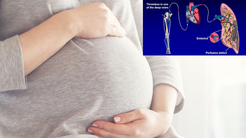 Thuyên tắc phổi ở phụ nữ mang thai: Nguyên nhân, triệu chứng và cách phòng ngừa 1