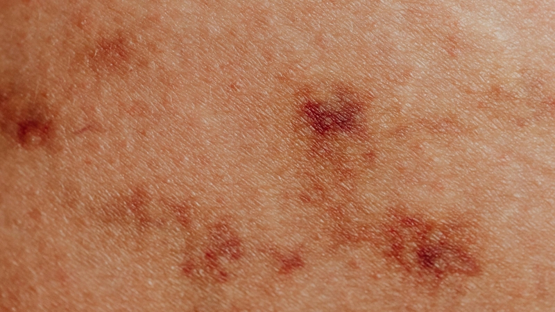 Tia UVB khiến da bị sạm màu, khô ráp hoặc xuất hiện nếp nhăn sớm