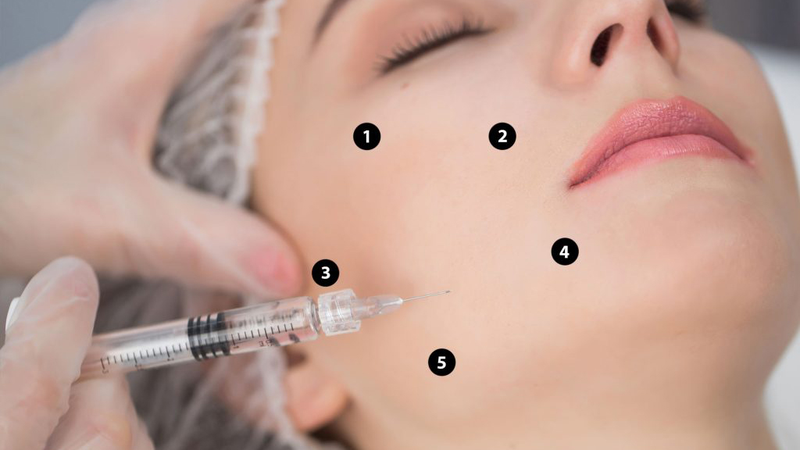 Tiêm bap là gì? Những điều bạn cần biết về kỹ thuật tiêm bap làm đẹp 1