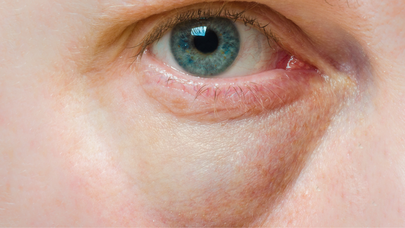 Tiêm bọng mắt cười có nguy hiểm không? 2