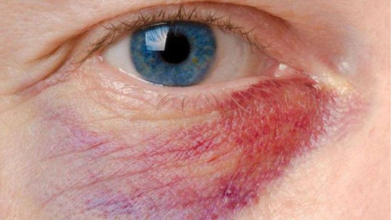 Tiêm botox ở đâu tốt? Tiêm botox mang lại tác dụng như thế nào? 2